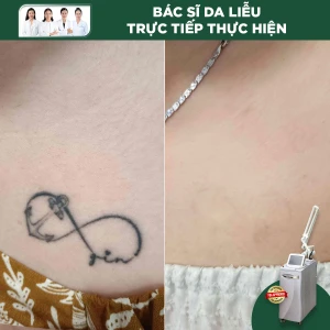 Xoá xăm bằng Laser Revlite - USA ( Diện tích < 5cm2)