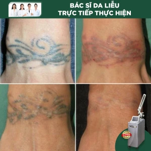 Xoá xăm bằng Laser Revlite - USA (Diện tích từ 10-20cm2)