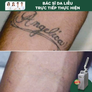 Xoá xăm bằng Laser Revlite - USA (Diện tích từ 5-10cm2)