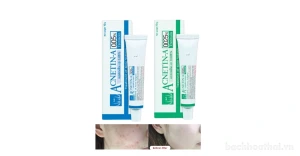 Kem thoa giảm mụn ẩn Vitara Acnetin-A Tretinoin Thái Lan